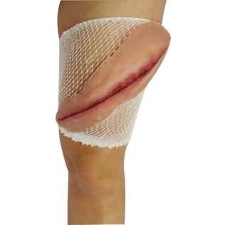 Plaie longue 27 cm sur filet